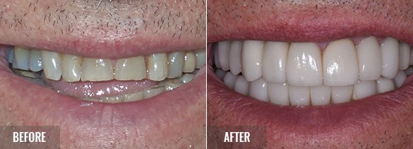 Full Mouth Rehabilitation - Before & After results 1