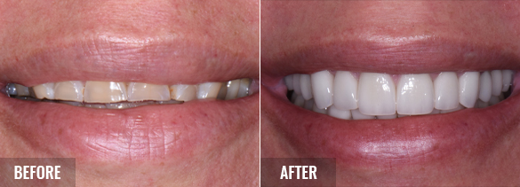 Full Mouth Rehabilitation - Before & After results 2