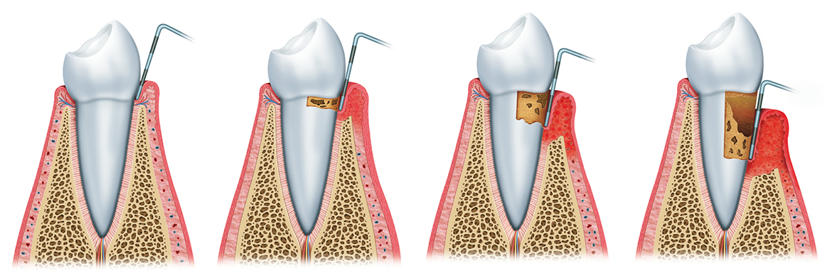 https://www.leporedentistry.com/wp-content/uploads/2020/03/scaling-and-root-planing-img-2.jpg